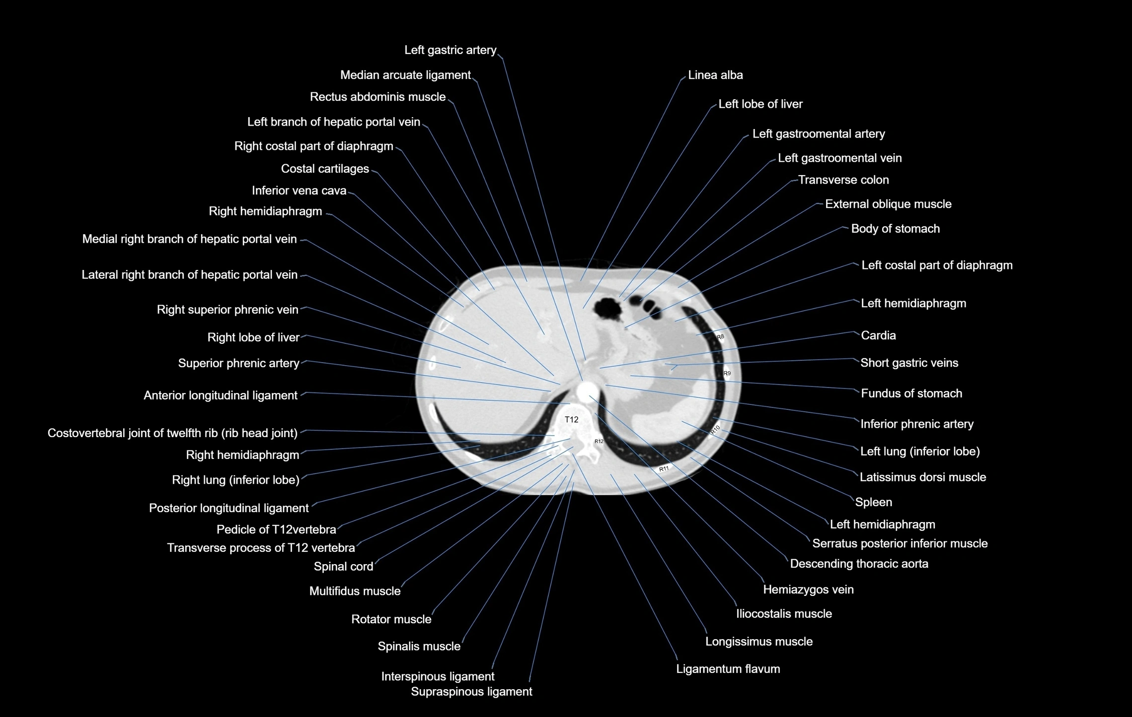 CT chest (thorax) lung window window labelled axial cross sectional anatomy radiology image-00111.webp